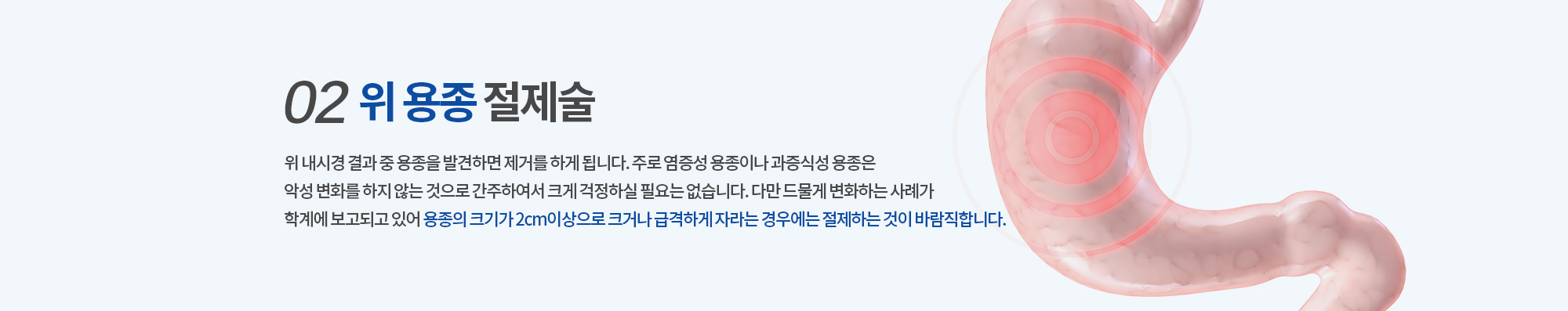 02. 위 용종 절제술
		위 내시경 결과 중 용종을 발견하면 제거를 하게 됩니다. 주로 염증성 용종이나 과증식성 용종은
		악성 변화를 하지 않는 것으로 간주하여서 크게 걱정하실 필요는 없습니다. 다만 드물게 변화하는 사례가 
		학계에 보고되고 있어 용종의 크기가 2cm 이상으로 큰 경우에는 절제하는 것이 바람직합니다. 